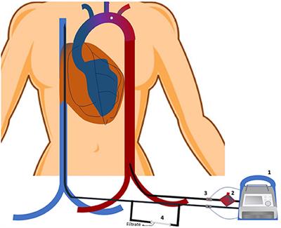 Frontiers | Overview of Veno-Arterial Extracorporeal Membrane